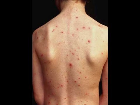 how to get rid of back acne uk