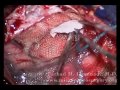 Careful removal of metastatic brain tumor