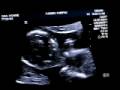 Baby Peanut - 13 weeks - 12/3/08