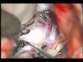 brain aneurysm clipping
