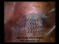 Laparoscopic Sacrocolpopexy Laparoscopic Sacrocolpopexy