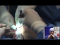 Eyelid Surgery in 10 Minutes