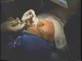 Eye Lift Procedure