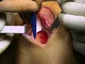 Osteochondral Allograft (sample) - www.proceduresconsult.com