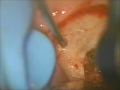 Click here to watch this video 歯根端切除後の再根管治療2