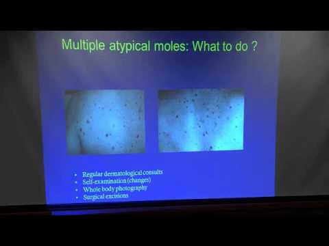 Early Melanoma Detection
