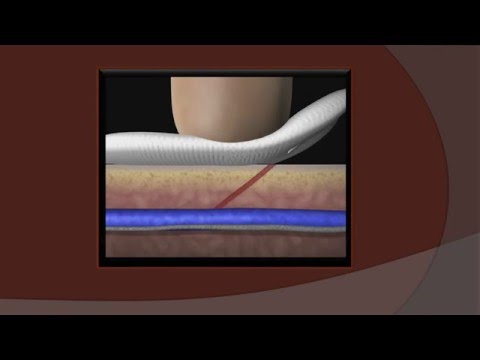 video-linktoworks-Post-venipuncture Pressure. How much? How long?