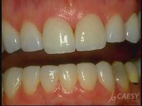 BONDING - Veneers, Lumineers, Teeth Bonding, white fillings, teeth whitening, dental implants, invisalign.