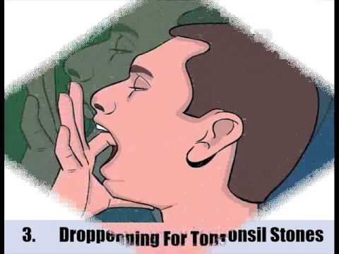 how to cure tonsil