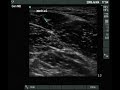 Ultrasound view of the obturator nerve