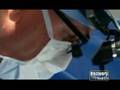 Transposition of the great arteries - Part 2