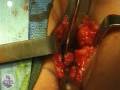 Triple Innominate Osteotomy for DDH
