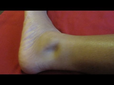 how to relieve edema in feet
