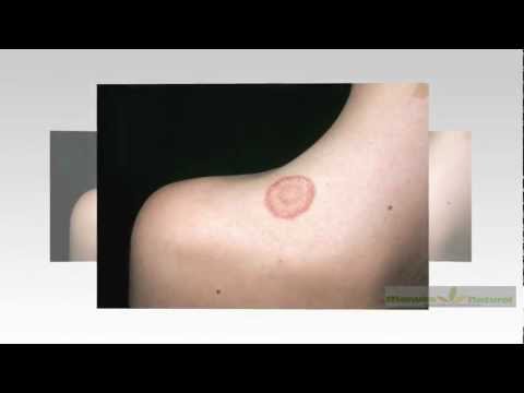 how to treat ringworm in cats nz
