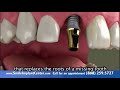 A Single Implant - Why replace missing teeth?
