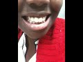 High Speed Braces - French