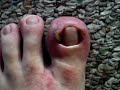 My ingrown toe nails (1)