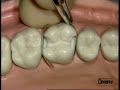 Dentsply - Palodent Demonstration on a dental model