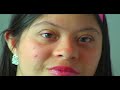 Down syndrome:&nbsp;S�ndrome (II)