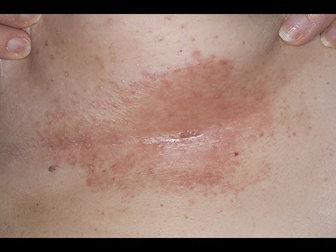 how to treat underarm rash