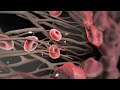 Atherosclerosis