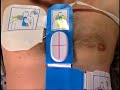 AED Training Video --Update AED Training Video --Update