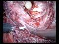 videos de European Urology - Surgery In Motion - May 2008 video