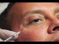 Botox Before and After Crows Feet