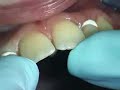 straumann dental implant Cemented single-tooth restoration 3 straumann dental implant Cemented single-tooth restoration 3