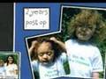 Luke's Craniosynostosis