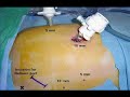 Laparoscopic Extraperitoneal Aortic Lymph Node Dissection #1 Laparoscopic Extraperitoneal Aortic Lymph Node Dissection #1