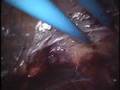 Laparoscopic Extraperitoneal Aortic Lymph Node Dissection #1