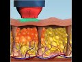Thermage Cellulite Animation Thermage Cellulite Animation