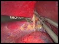 Surrenectomia dx VL.wmv