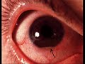 Behcet's Disease PSA Behcet's Disease