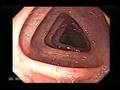 Endoscopia del Colon (Colonoscopia)