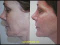 Michael Persky, MD - Fraxel re:pair with Marta Waller 11 Michael Persky, MD - Fraxel re:pair with Marta Waller 11