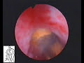 Percutaneous Nephrolithotomy for big kidney stones PCNL Percutaneous Nephrolithotomy for big kidney stones PCNL