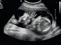 Wonderful ultrasound of surrogacy twins Wonderful ultrasound of surrogacy twins