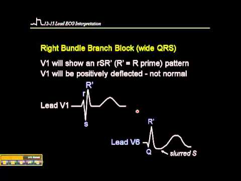 how to treat rbbb