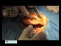 Chirurgie RETROX/RETROX Surgery Chirurgie RETROX/RETROX Surgery