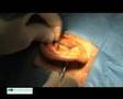 Chirurgie RETROX/RETROX Surgery