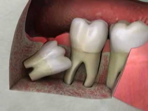 how to treat wisdom tooth pain