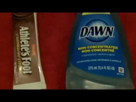 how to cure jock itch without cream