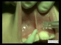 laser - frenectomy operation/operazione di frenectomia