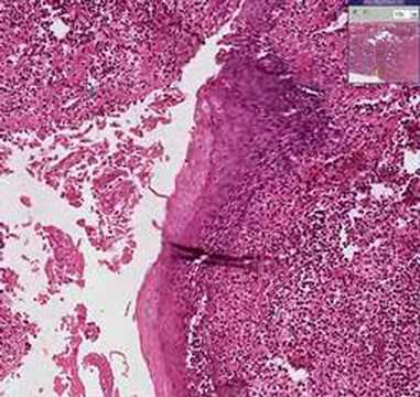 Histopathology Larynx--Haemophilus ...