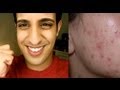 So bekämpfst DU Akne&Pickel für IMMER! 5 Geheimtipps!! - How To Get Rid of ACNE! - HerrTutorial