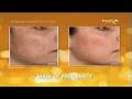 videos de Discover Fraxel : Dr Gerrish