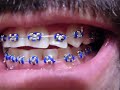 braces update 3-4-8