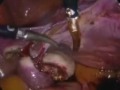Laparoscopic Supercervical Hysterectomy